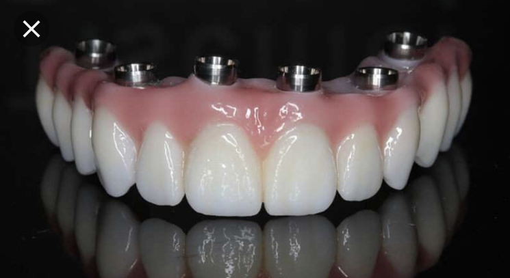 Detalhe da prótese fixa sobre implantes dentários do Protocolo de Branemark
