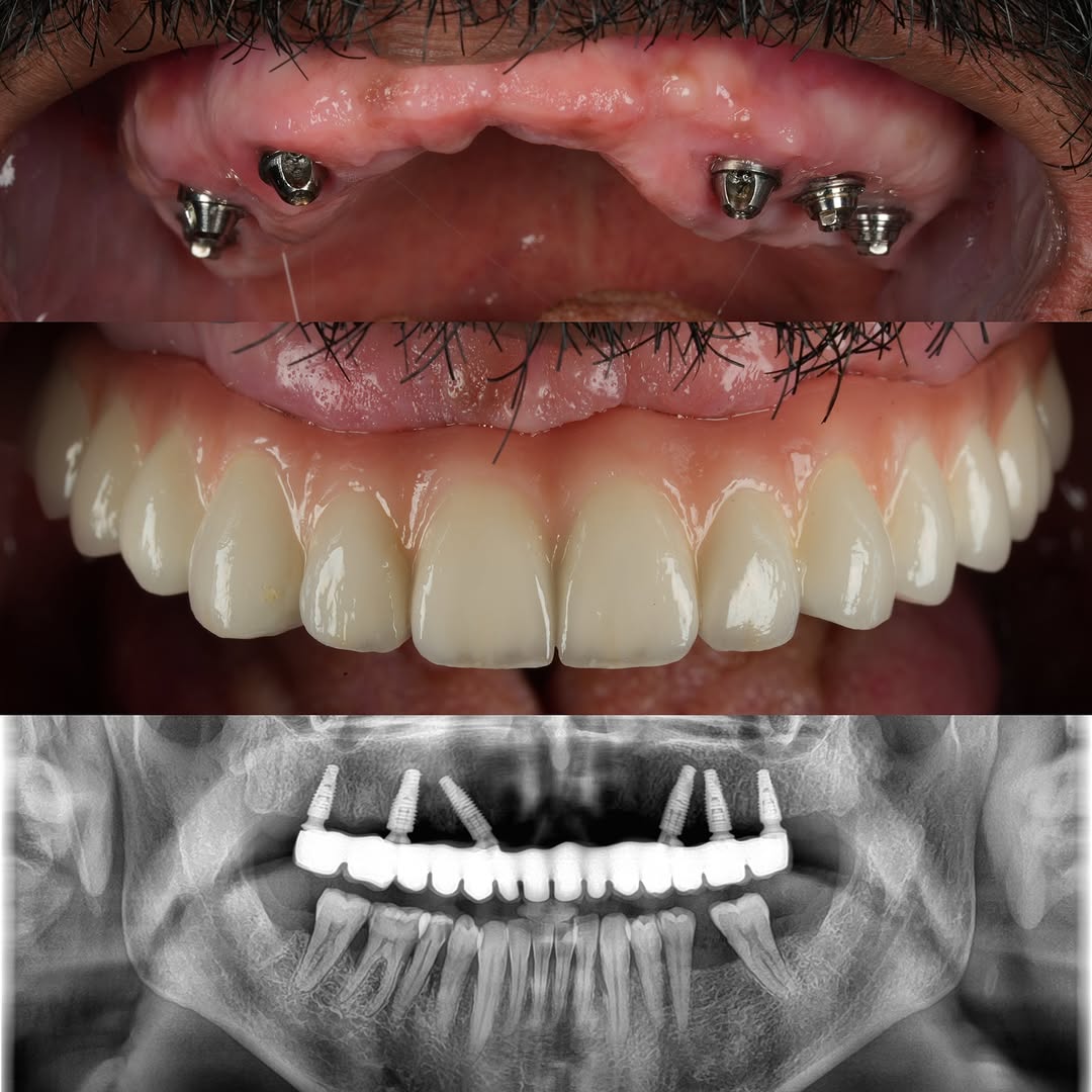 Sequência de reabilitação com Protocolo de Branemark: implantes dentários, prótese fixa e raio-X em Uberlândia